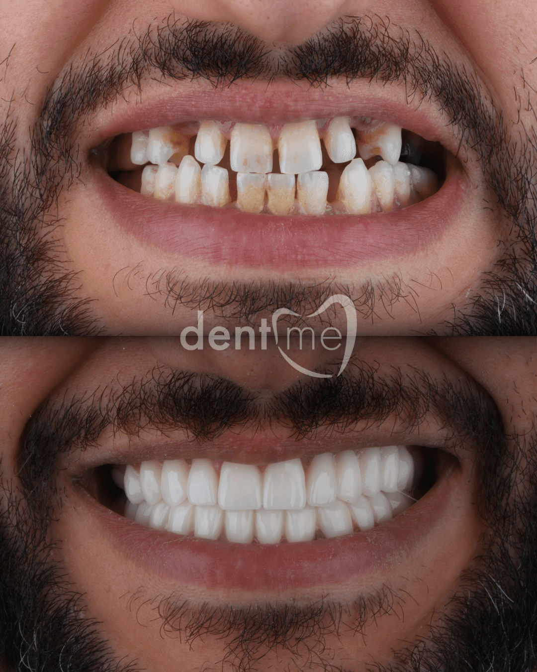 DentME