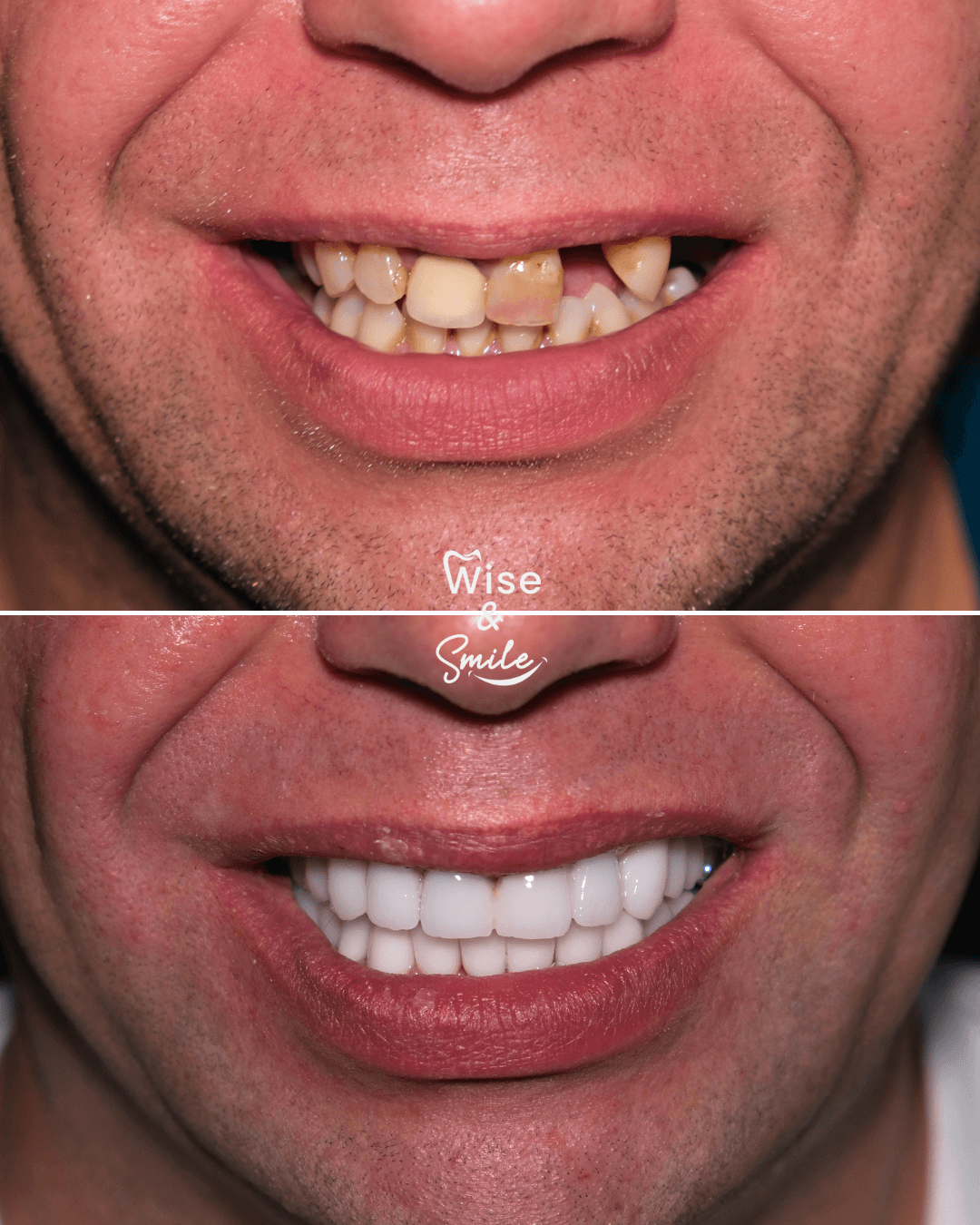 Before/After Dönüşüm